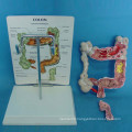 Human Pathological Colon Anatomy Model for Medical Teaching (R100201)